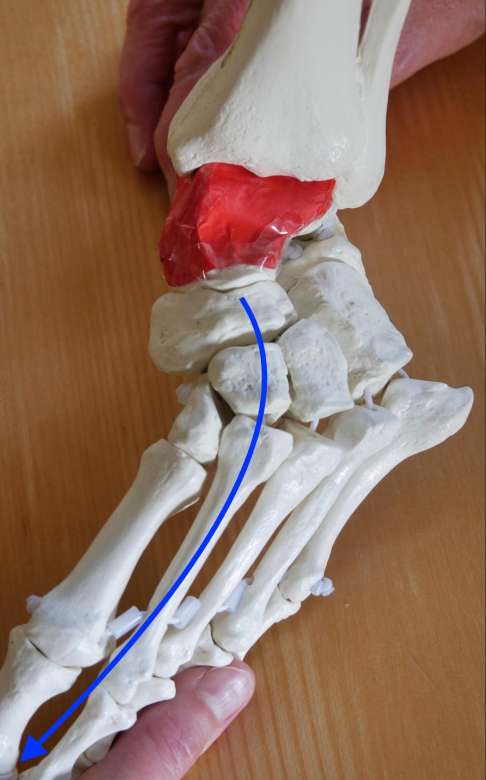 Klumpfüße bestehen aus einer Kombination komplexer Fehlbildungen und haben ihre Ursache in Knochenverschiebungen unterhalb des Sprungbeins (Talus, hier rot dargestellt), zusammen mit krankhaft verändertem Weichteilgewebe.