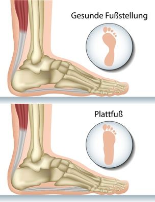 Plattfuß und gesunder Fuß im Vergleich