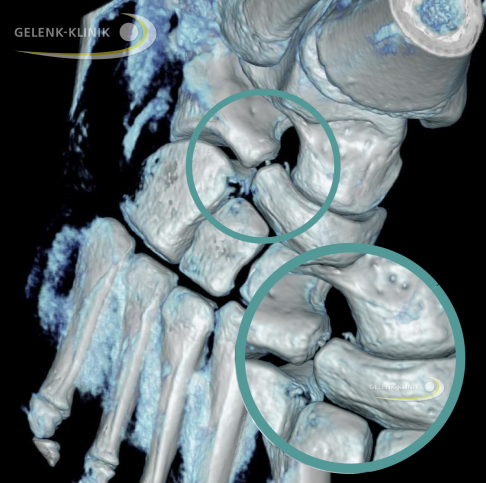 Digitale Volumentomographie einer inkompletten Coalitio calcaneonavicularis