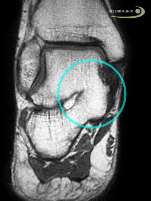 Magnetresonanztomographie (MRT) bei einem Patienten mit kompletter Koalition