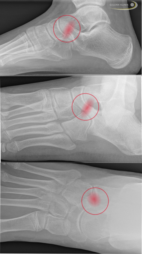 Röntgenbefund einer Coalitio calcaneonavicularis