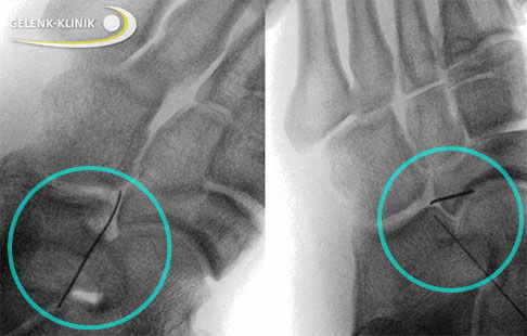 Röntgenaufnahme während der minimalinvasiven Operation