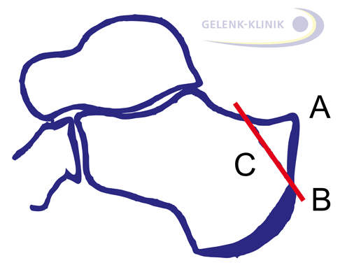 Planungsskizze für die Operation der Haglundferse