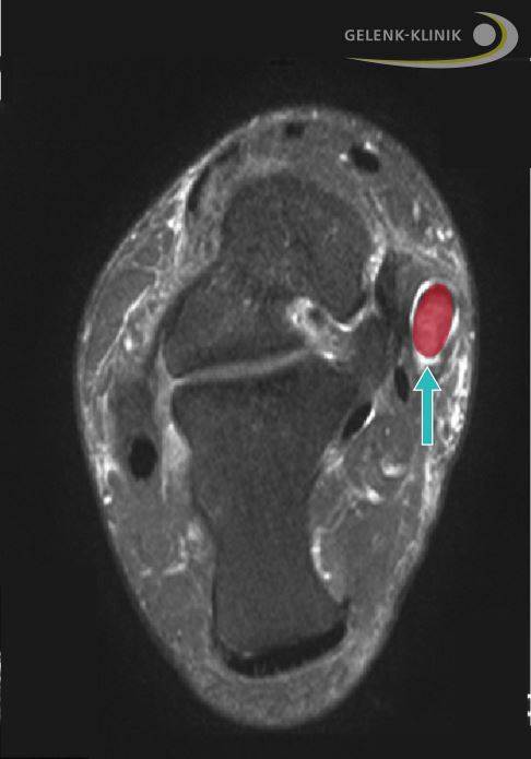 MRT: Schwäche der Tibialis-posterior-Sehne