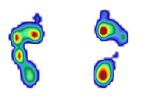 lähmungsbedingter Hohlfuß in der Fußdruckmessung (Pedobarografie)