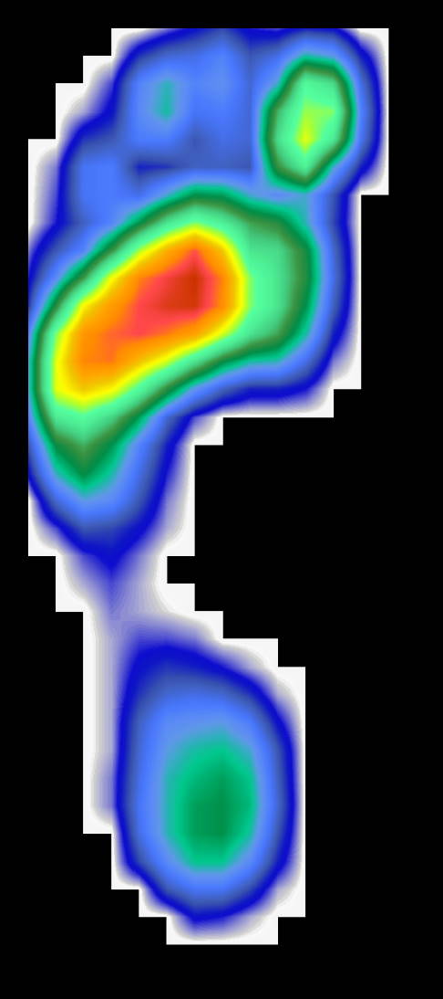 Fußdruckmessung bei einem Spreizfuß