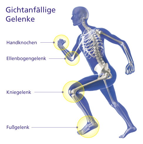 Gicht Arthritis Urica Ursachen Symptome Behandlung Gelenk Klinik De