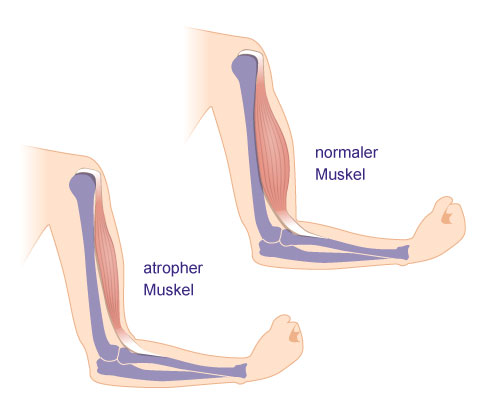 Vergleich: normaler und atropher Muskel