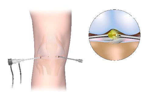 .Bei der Kniearthroskopie führt der Operateur das Arthroskop (links) und, wenn erforderlich, feine Instrumente (rechts) über jeweils einen kleinen Hautschnitt in das Gelenk ein. © Alila Medical Media, Adobe Illustration einer Kniearthroskopie