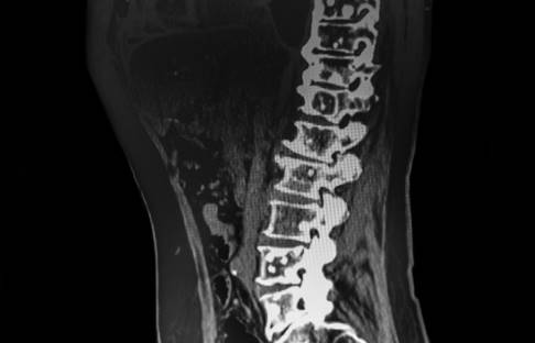 CT-Bild von Metastasen in der Wirbelsäule