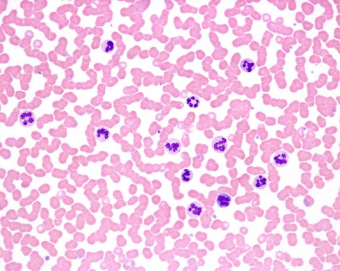 Blutausstrich mit angefärbten Erythrozyten und Leukozyten. Die Erythrozyten erkennt man daran, dass sie wie hellrosa Scheiben aussehen. Da sie keinen Zellkern besitzen, ist ihre Mitte hell. Die Leukozyten (weiße Blutkörperchen) sind größer und weisen einen dunkel gefärbten Zellkern auf. In diesem Blutausstrich ist das Verhältnis Erythrozyten/Leukozyten zugunsten der Leukozyten verschoben. Es liegt eine Leukozytose vor. © JosLuis, Adobe Leukozyten