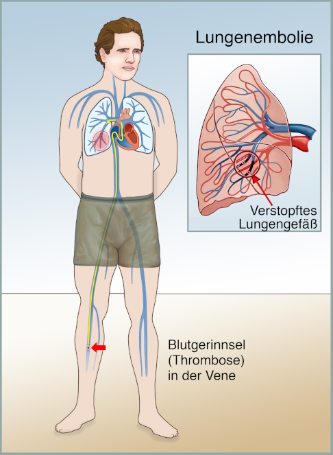 Weg eines Blutgerinnsels vom Bein bis zur Lunge