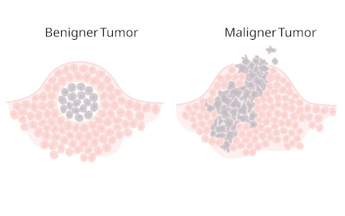 Benigner und maligner Tumor
