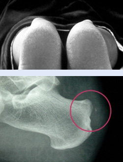 patient with Haglund's syndrome