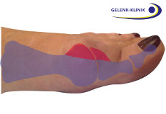 Klinisches Bild einer Arthrose im Großzehengrundgelenk: Der Hallux rigidus äußert sich durch eine Verengung des Gelenkspalts mit resultierender eingeschränkter Beweglichkeit des Großzehs. © Gelenk-Klinik Seitliche Ansicht eines Hallux rigidus (Arthrose im Großzehengrundgelenk)