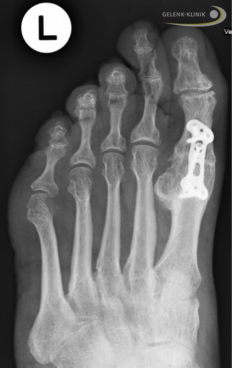 Die Arthrose des Großzehengrundgelenks (GZG) kann durch eine Versteifung (Arthrodese) behandelt werden. Nach der Resektion des GZG können die Knochen durch Schrauben oder Platten (wie in diesem Röntgenbild) verbunden werden. In der Heilungsphase verknöchern Mittelfußknochen und Grundglied des Zehs und wachsen zusammen. © Gelenk-Klinik Röntgenbild einer Plattenarthrodese