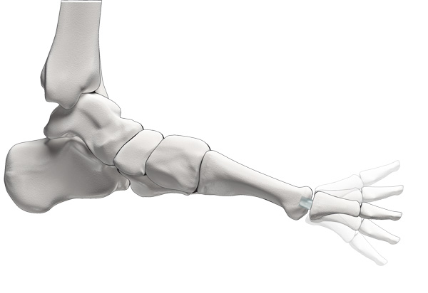 Die CARTIVA® Teilprothese besteht aus einem elastischen, wasserbindenden Kunsstoff mit knorpelähnlichen Eigenschaften. Das elastische Implantat wird in den Knochen des 1. Zehenstrahls (Os metatarsale) verankert. Der 1. Zehenknochen mit der Gelenkpfanne des MTP-Gelenks als Gelenkpartner bleibt unverändert.