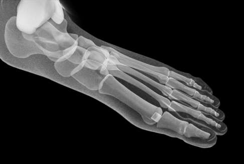 Elastischer Knorpelersatz zur Versorgung des Hallux rigidus. © CARTIVA Inc. Knorpelersatzimplantat der Großzehe