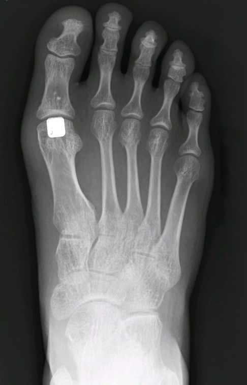 CARTIVA-Implantat im Röntgenbild