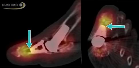 Vollprothese des Großzehengrundgelenks im SPECT-CT: Das bildgebende Verfahren zeigt Knochenumbauprozesse unter Kontrastmittelgabe. Auf diese Weise kann der Arzt eine Lockerung der Prothese feststellen. © Gelenk-Klinik Vollprothese des Großzehengrundgelenks im SPECT-CT
