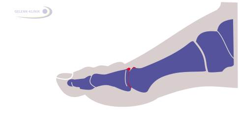 Схематическое изображение Hallux rigidus: отчетливо видно суженая суставная щель артритного сустава. На прогрессирующей стадии суставные поверхности образуют костные наросты (остеофиты), которые обозначены красным цветом. Остеофиты имеют свойство компенсировать распределение давления в суставе. © Gelenk-Klinik