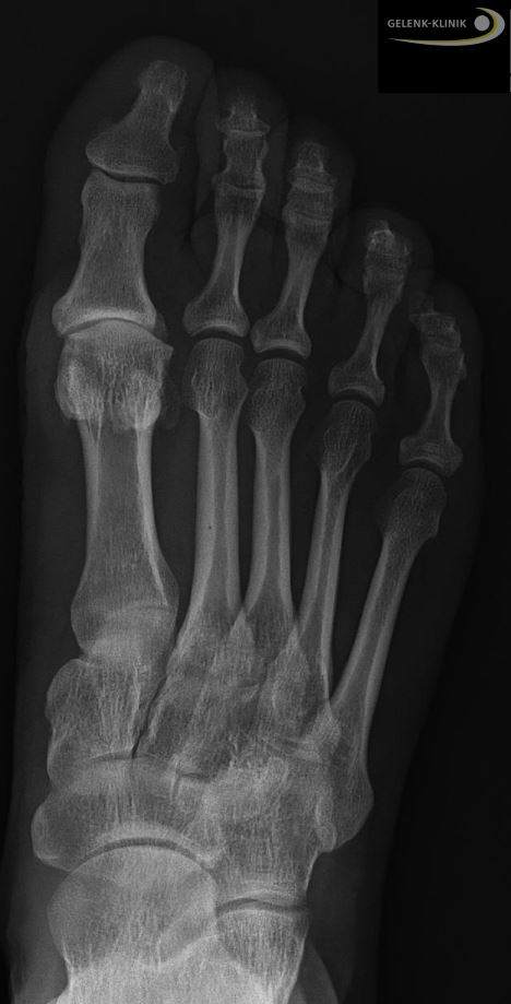 Hallux rigidus im Röntgenbild