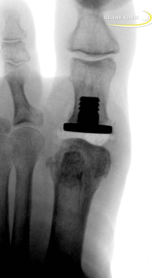 Рентген частичного эндопротеза для лечения артроза первого плюснефалангового сустава (Hallux rigidus). © Gelenk-Klinik