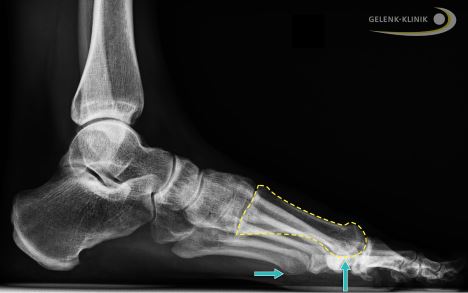 Röntgenbild eines Hallux elevatus