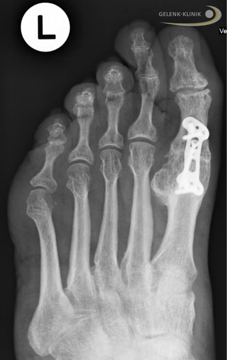 Röntgenbild einer Arthrodese des Großzehengrundgelenks