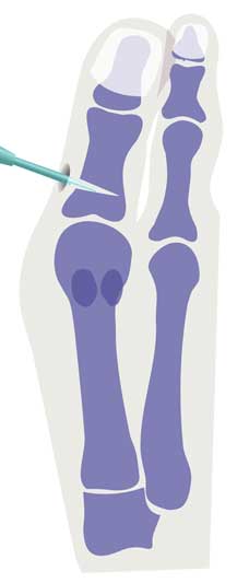 При помощи микроскопической фрезы из кости большого пальца извлекается небольшой клин. © Dr. med. Thomas Schneider 