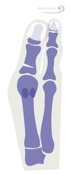 Mild hallux valgus interphalangeus: Osteotomy prior to reposition of the big toe. © Dr. Thomas Schneider, MD 