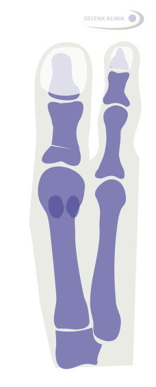 На месте извлечения костного клина большой палец стопы помещается в правильное положение © Dr. med. Thomas Schneider 