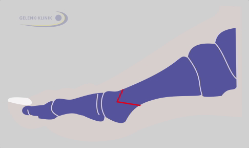 Planning for repositioning the bone (osteotomy) in Chevron surgery beyond the metatarsophalangeal joint. With Chevron osteotomy, a V-shaped cut is made behind the first metatarsal head. It is then moved outward and secured in place with a small titanium screw.