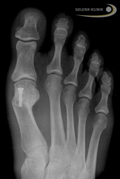 Hallux valgus nach Chevron-Osteotomie