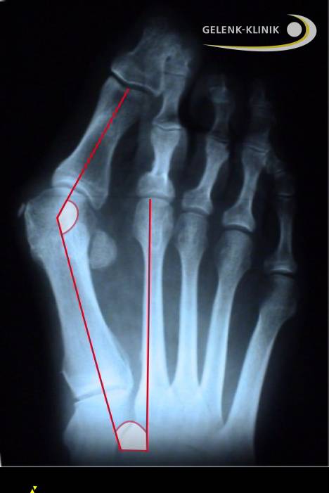 Рентгенограмма тяжелой формы Hallux valgus: Видимая деформация сесамовидных костей, тянущихся к 1-ому пальцу. Смещение 1-ого пальца по отношению к плюсневой кости © Gelenk-Klinik.de