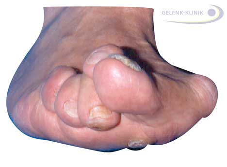 Der Hallux valgus kann die benachbarten Zehen verdrängen