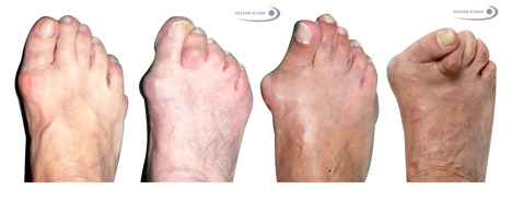 Stages of hallux valgus deformity increasing from left to right.