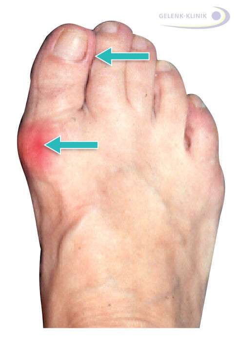 Hallux valgus mit leichter Fehlstellung