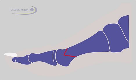 Osteotomy (bone repositioning): The direction of the foot ray can be changed permanently with a cut to the bone (red line) and realignment. Once healed, the change of direction can permanently correct hallux valgus. The chevron osteotomy shown here is one of many repositioning options which can be used based on the individual case. © Dr. Thomas Schneider, MD