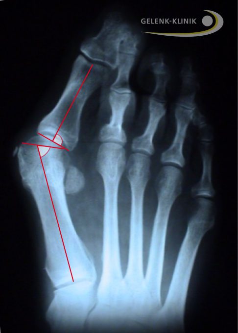 Foot with hallux valgus deformity