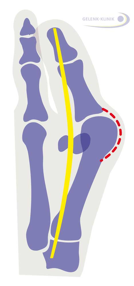 Hallux valgus: The tendon of the big toe runs at an angle to the metatarsophalangeal joint. The sesamoid bones which guide the toe flexor tendon are no longer to the right and left of the big toe but have noticeably shifted. The toe rotates out of the metatarsophalangeal joint, just like a bow is increasingly strained by the string. 