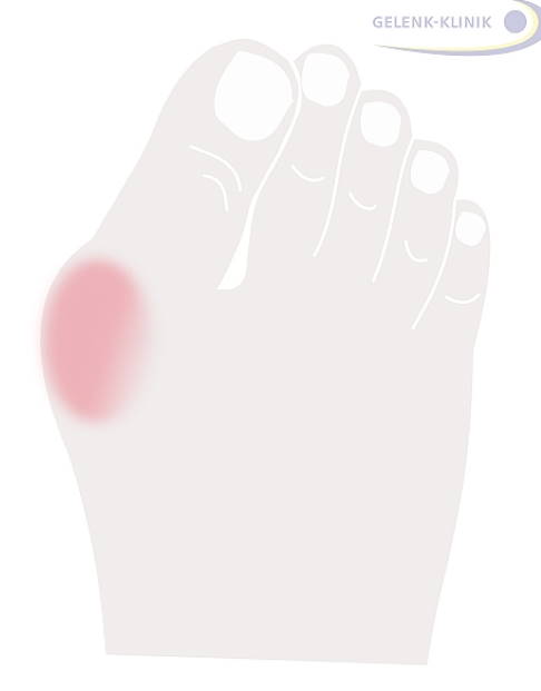 Wegmassieren hallux Hallux valgus