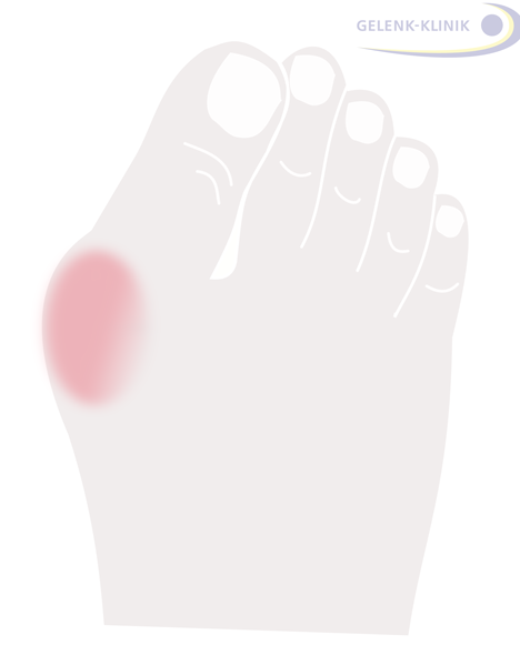 The hallux valgus (lat. for skewed toe) is a deformity in the big toe at the metatarsophalangeal joint: It is characteristic for the big toe to point outwards. Due to increasing conflict with the shoe, friction causes an inflammation of the bursa in the metatarsophalangeal joint, often followed by additional swelling.