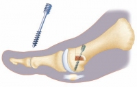 Umstellung (Osteotomie) des Zehenknochens