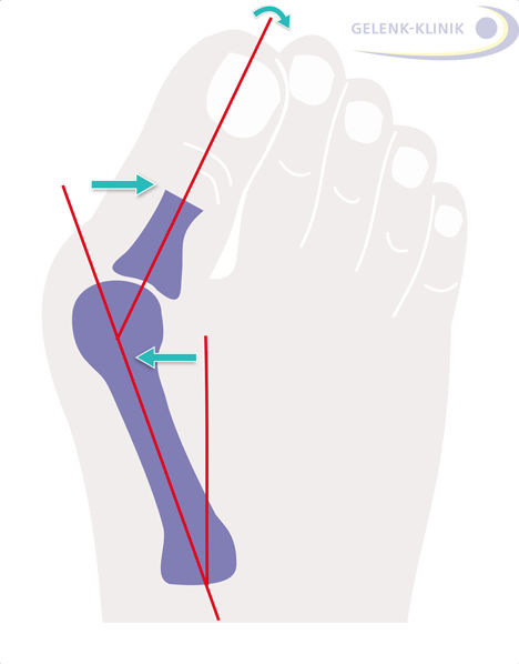 Fig. 1: Hallux valgus surgery corrects a misalignment of the big toe. Usually, the bone in the big toe is corrected in conjunction with the correction of the soft tissue of the joint capsule of the metatarsophalangeal joint. © Gelenk-Klinik.de