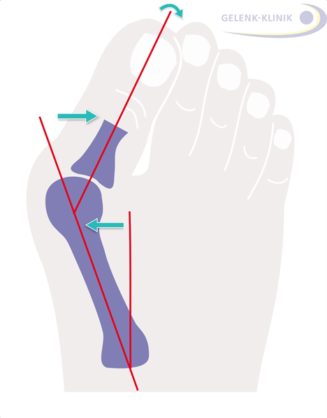 The degree of hallux valgus deformity is determined using the deviation of the big toe from the normal position.