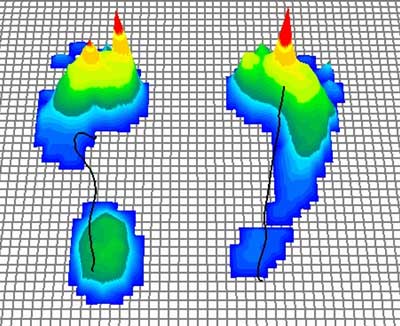 Pedobarografie bei Hallux valgus