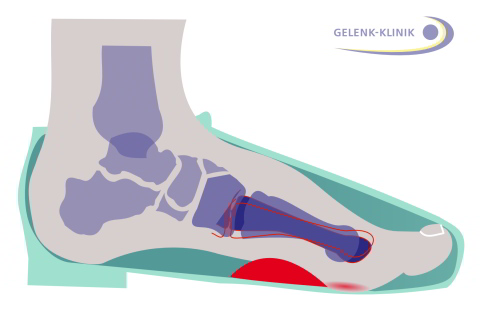 Insole for hallux valgus relieves the metatarsophalangeal joint