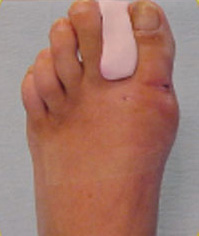 Fuß eines Patienten, acht Tage nach minimalivasiver Hallux valgus-Operation. © FH-Orthopaedics Hallux valgus nach minimalinvasiver OP