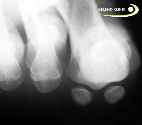 Röntgen: Sesambeine
